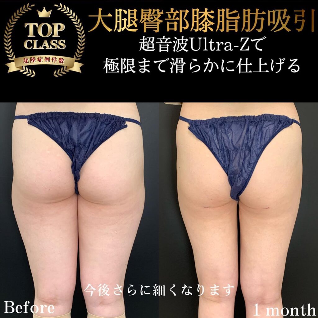 太ももの脂肪吸引の症例写真