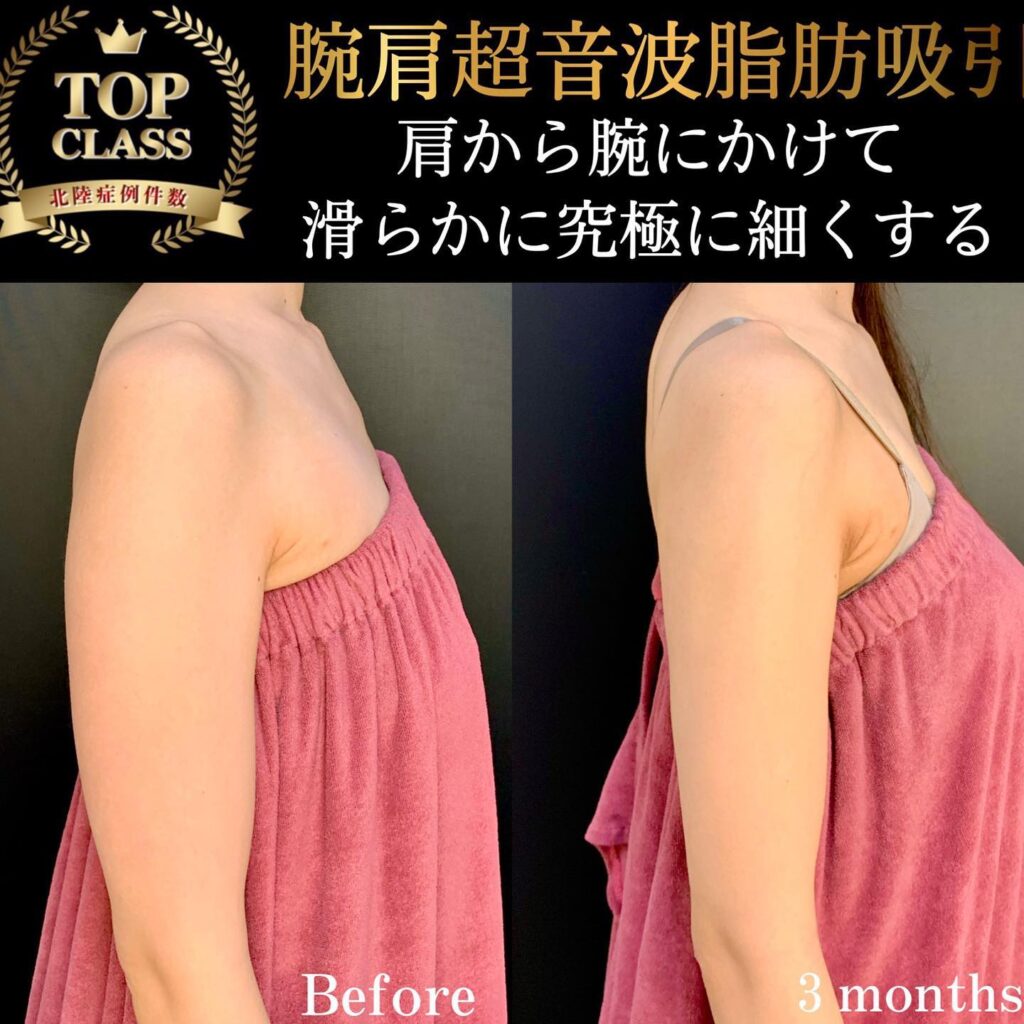 二の腕の脂肪吸引の症例写真