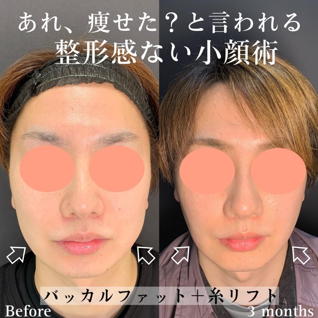 バッカルファットと糸リフトの症例写真 (2)