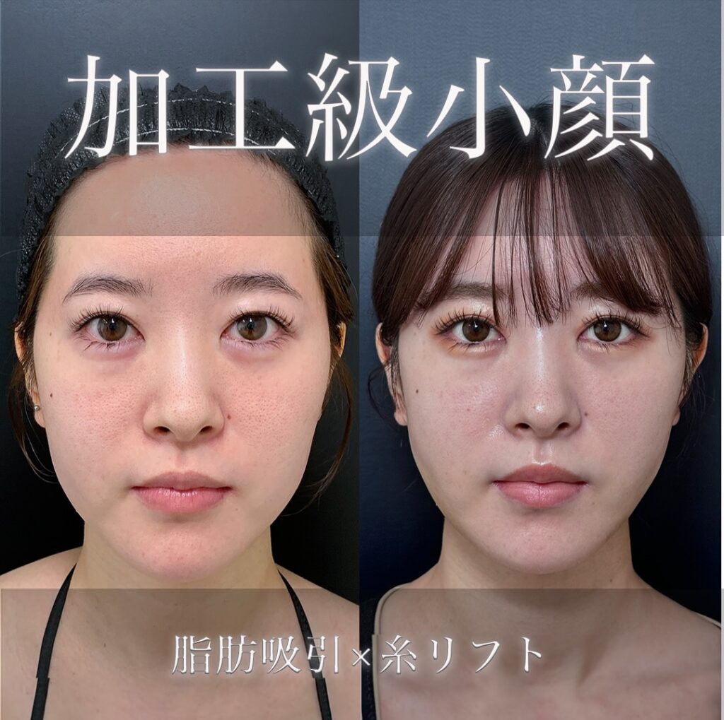 脂肪吸引と糸リフトの症例写真 (1)