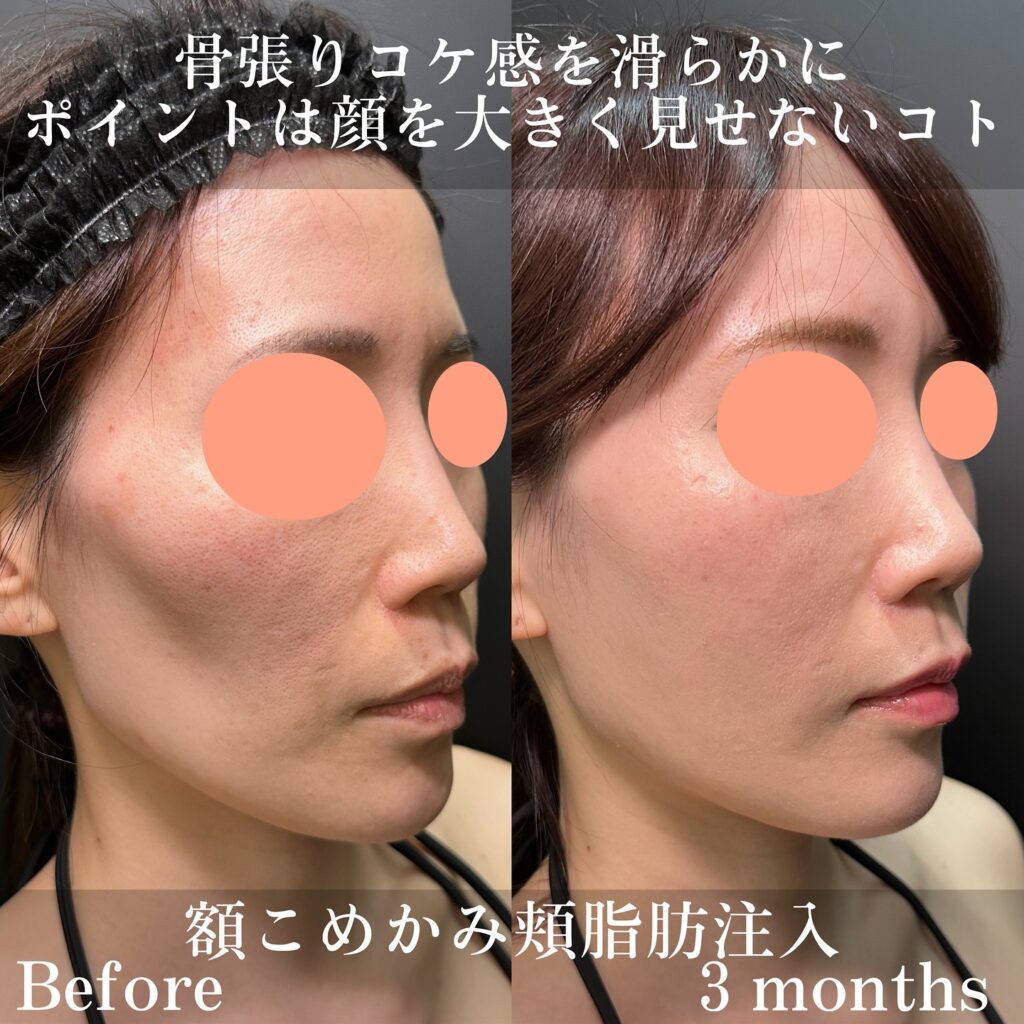 こめかみの脂肪注入の症例写真 (2)