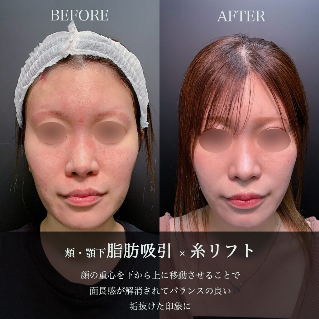 頬顎下の脂肪吸引と糸リフトの症例写真 (3)