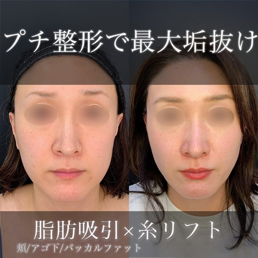 バッカルファットと頬と顎下の脂肪吸引と額こめかみの脂肪注入と糸リフトの症例写真 (4)
