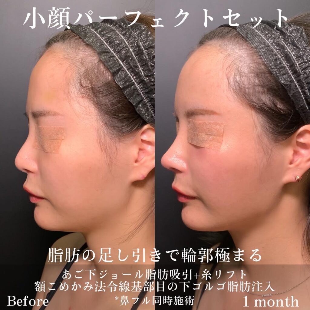 顎下のジョールファットと小顔脂肪吸引と糸リフトと脂肪注入と鼻フルの症例写真 (1)