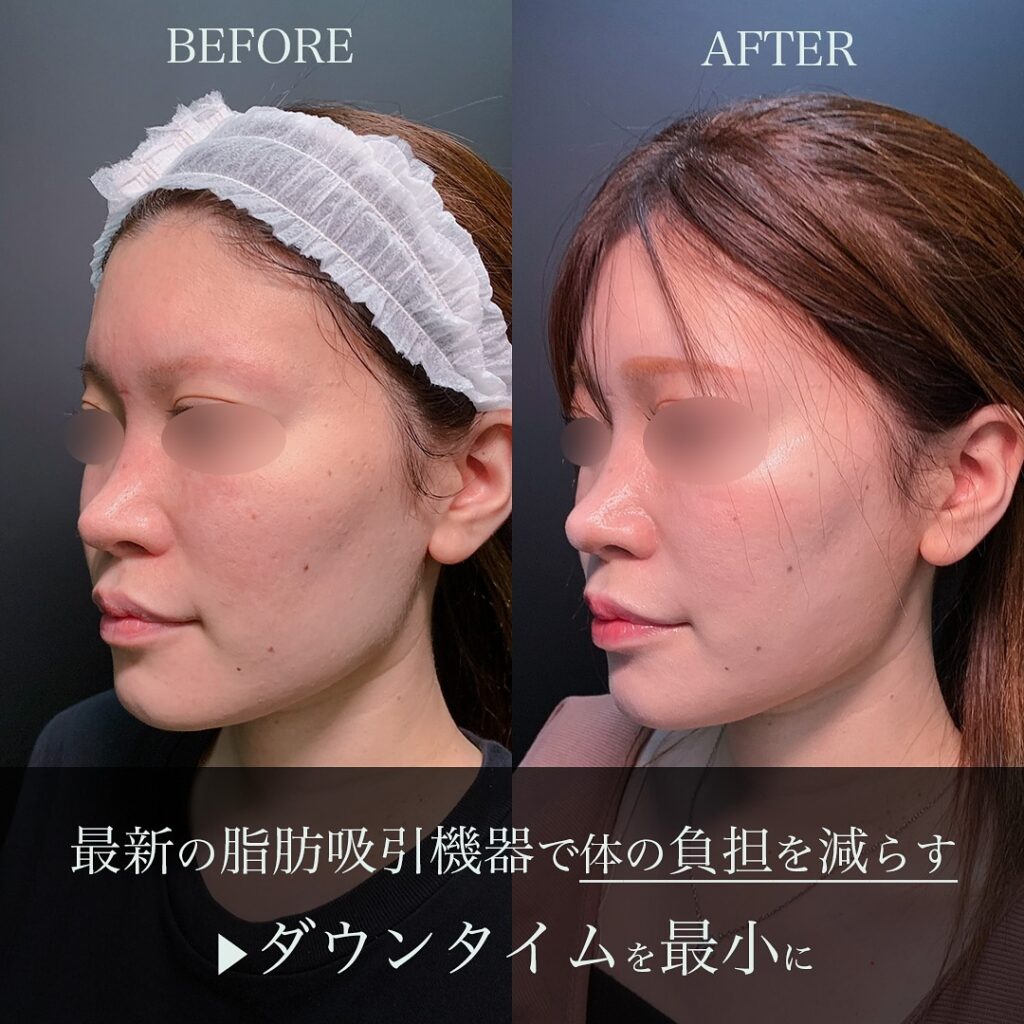 頬顎下の脂肪吸引と糸リフトの症例写真 (2)