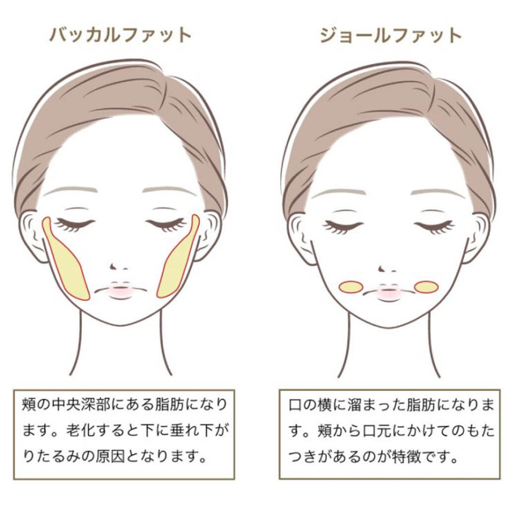 バッカルファットとジョールファットの違い