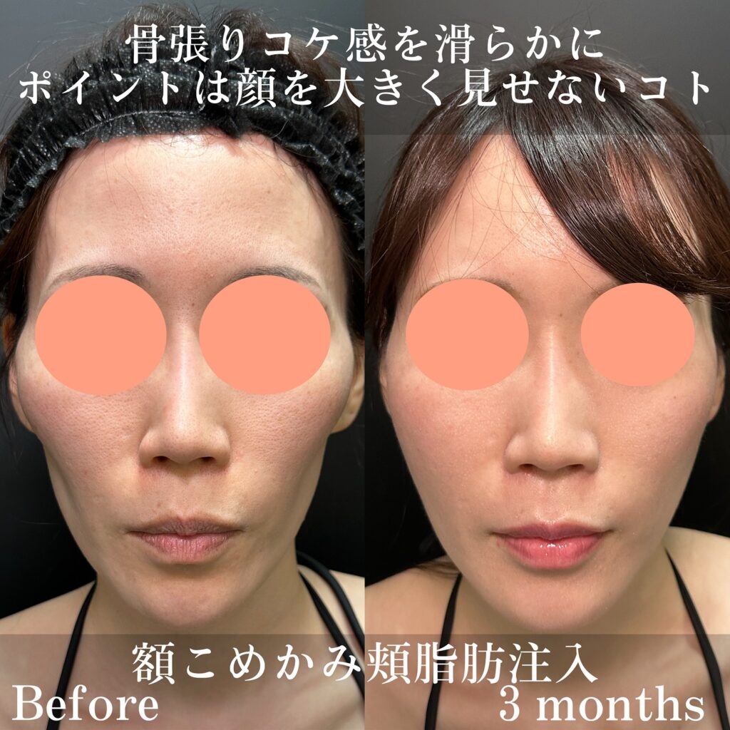こめかみの脂肪注入の症例写真 (1)