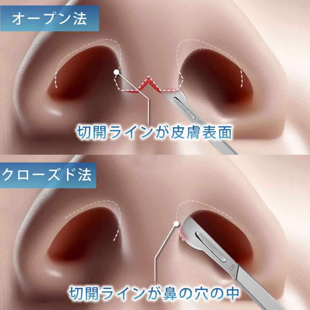 オープン法とクローズ法の傷跡の比較