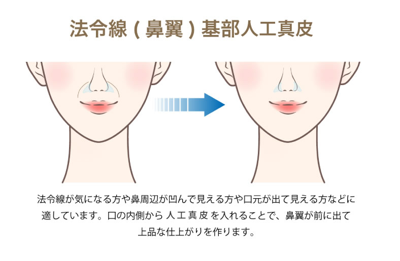 ほうれい線 人工真皮の図解