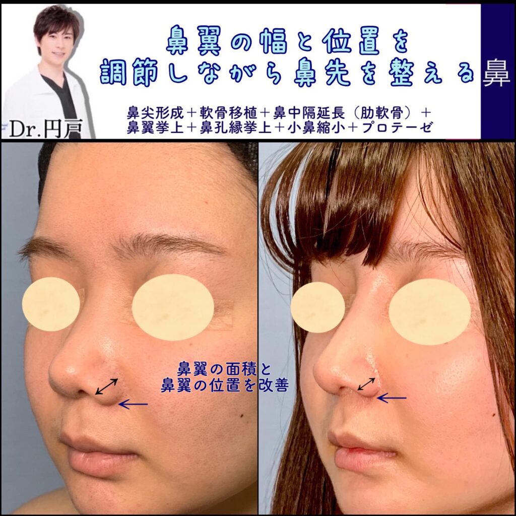 正面から見た時のスプレッダークラフトとインテグラルクラフトの図解