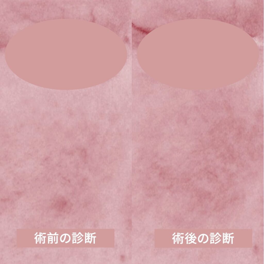 術前と術後の肌診断器による画像 (1)