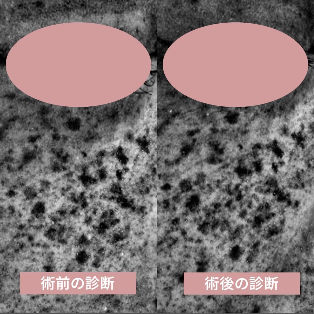 術前と術後の肌診断器による画像