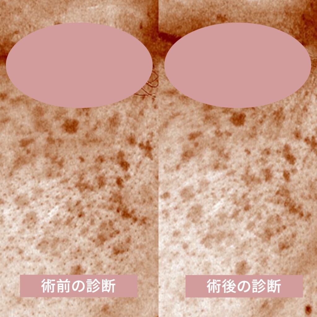 術前と術後の肌診断器による画像 (2)