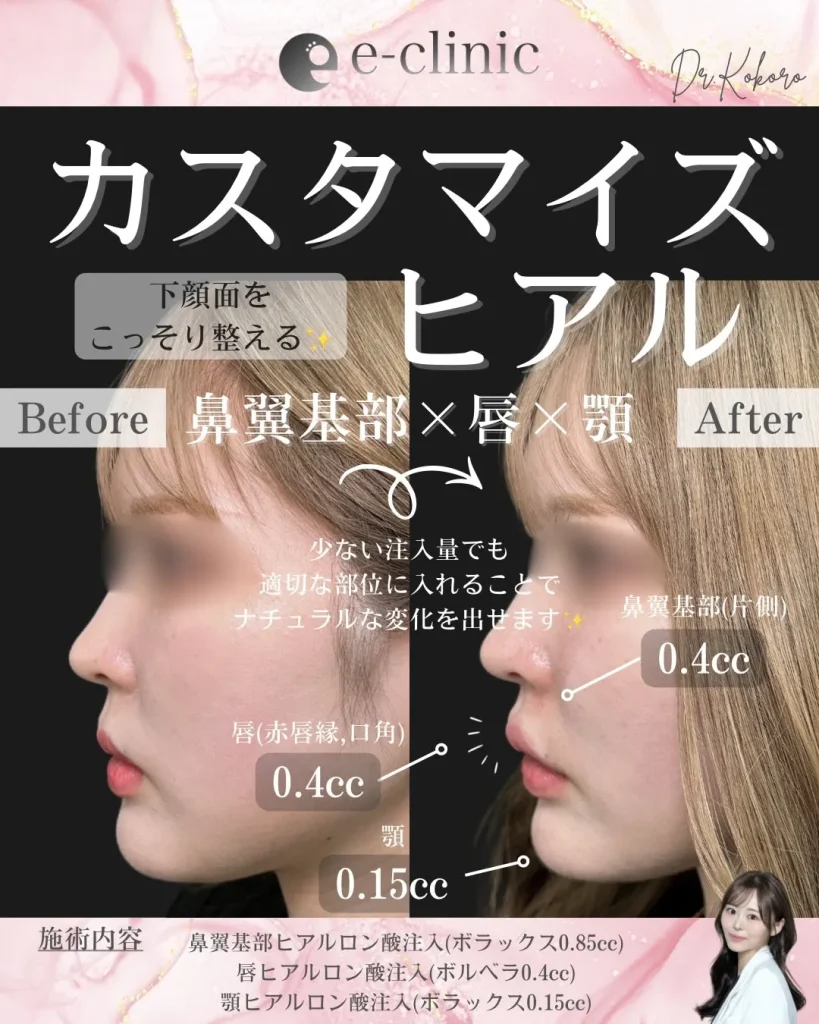 ヒアルロン酸（鼻翼基部・唇・顎）