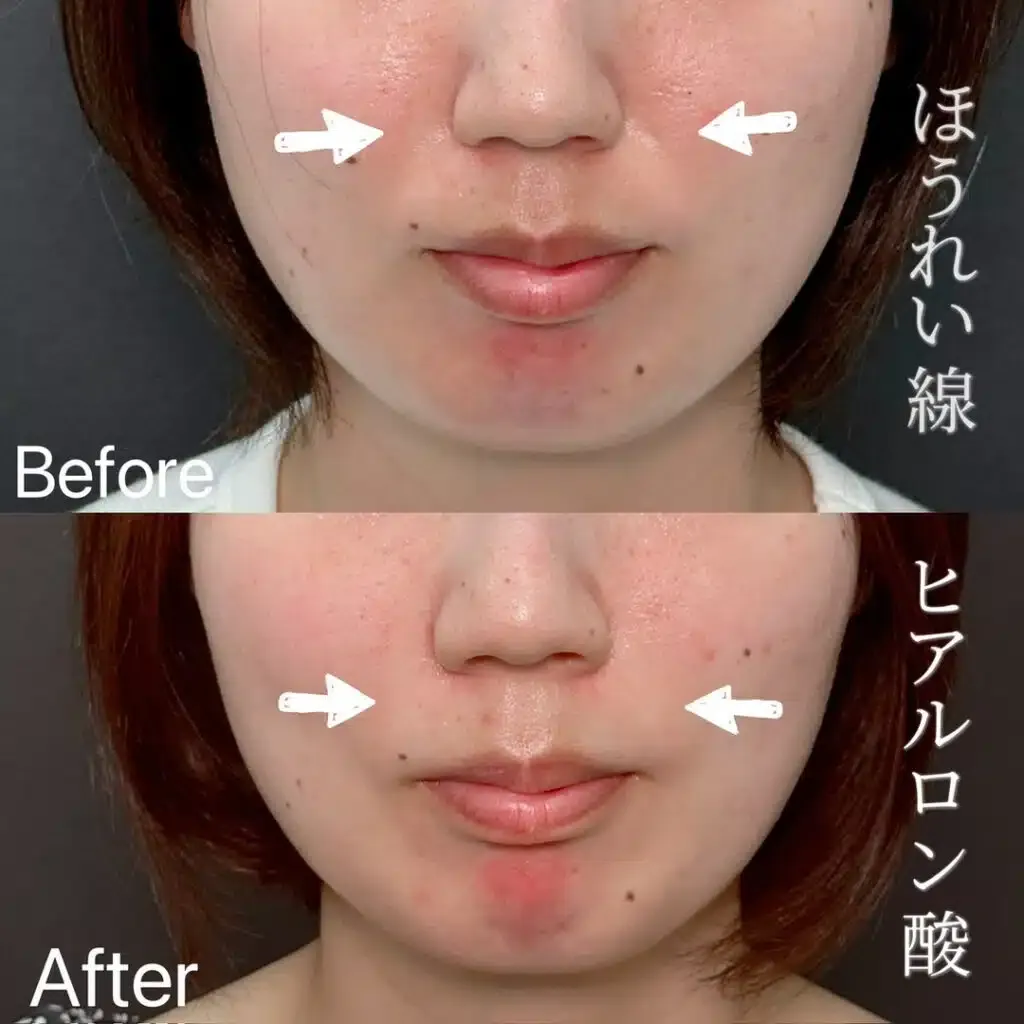 ほうれい線のヒアルロン酸ちゅにゅうの症例写真 (1)