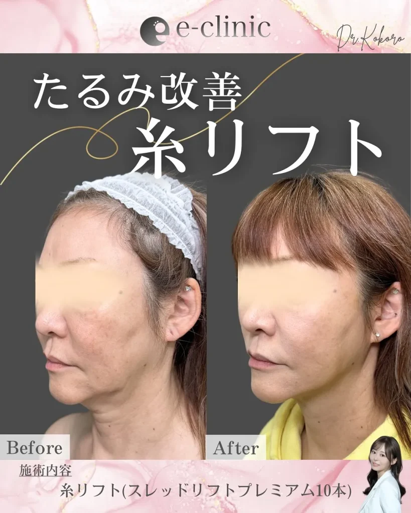 糸リフト