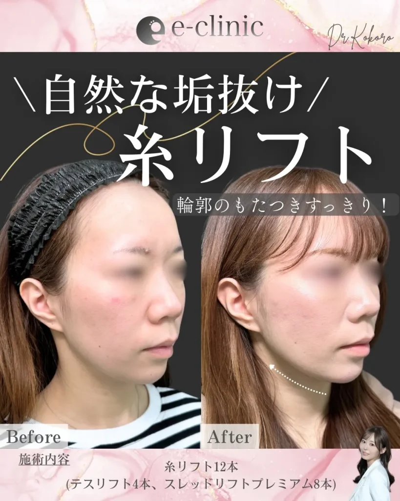 糸リフト