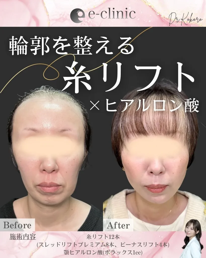 糸リフト＋ヒアルロン酸