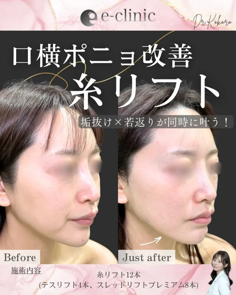 糸リフト