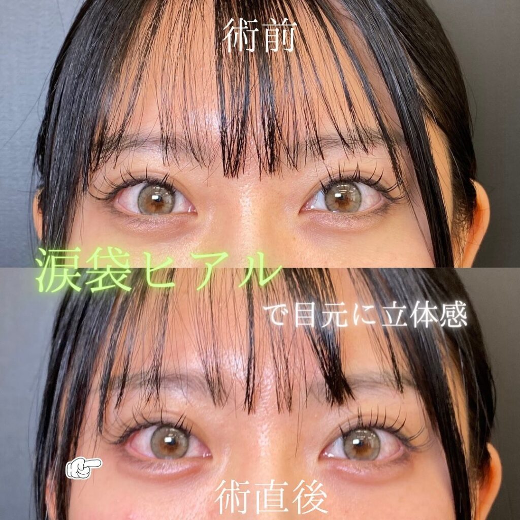 涙袋のヒアルロン酸の症例写真の