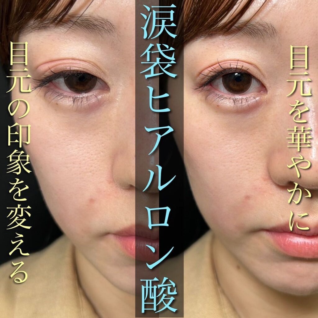 涙袋のヒアルロン酸の症例写真の