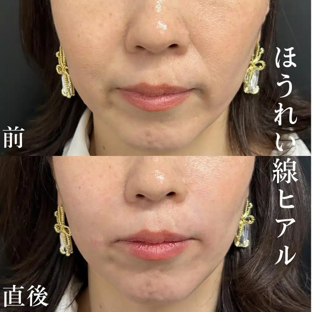 ほうれい線のヒアルロン酸の症例写真