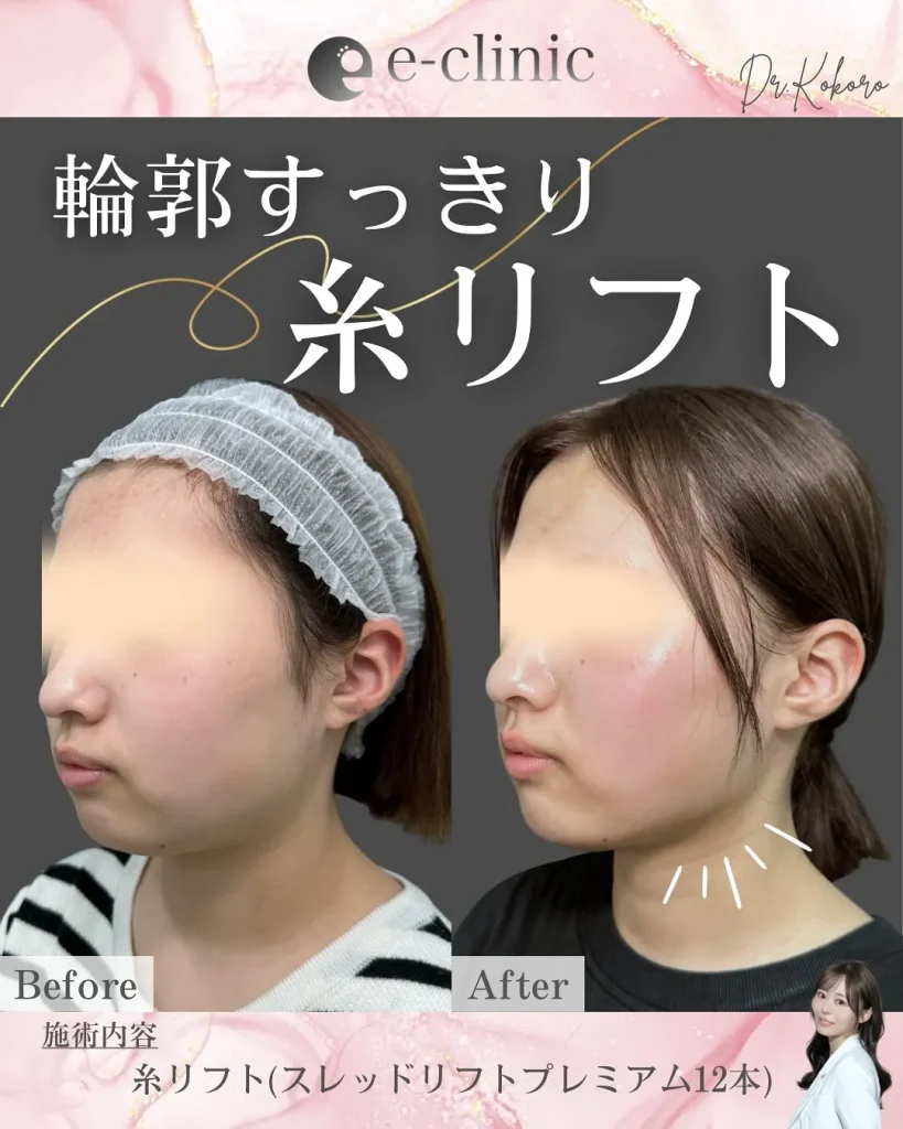 糸リフト