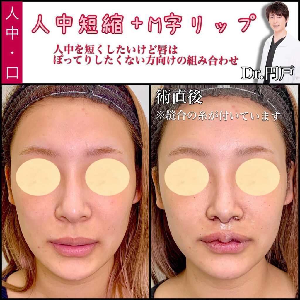 人中短縮とM字リップの症例写真 (2)