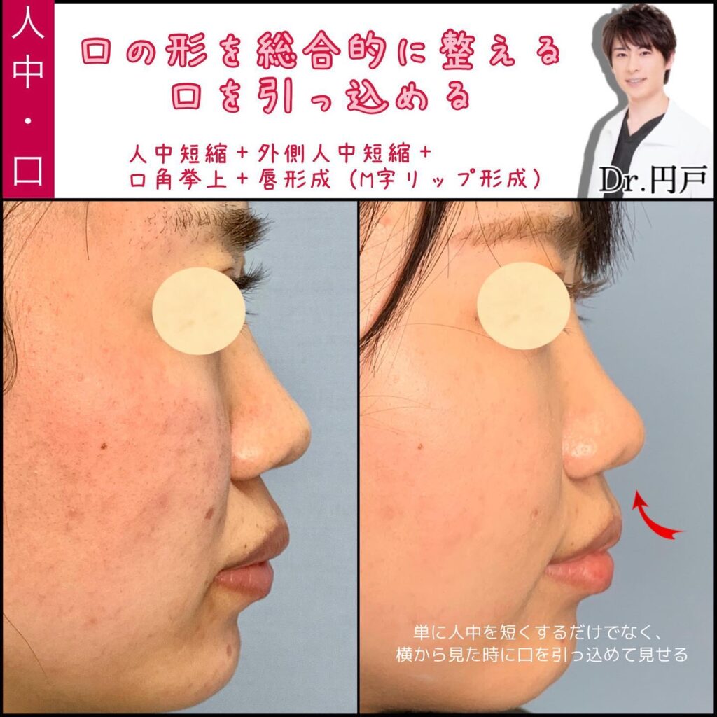 人中短縮と口角挙上とM字リップの症例写真 (2)