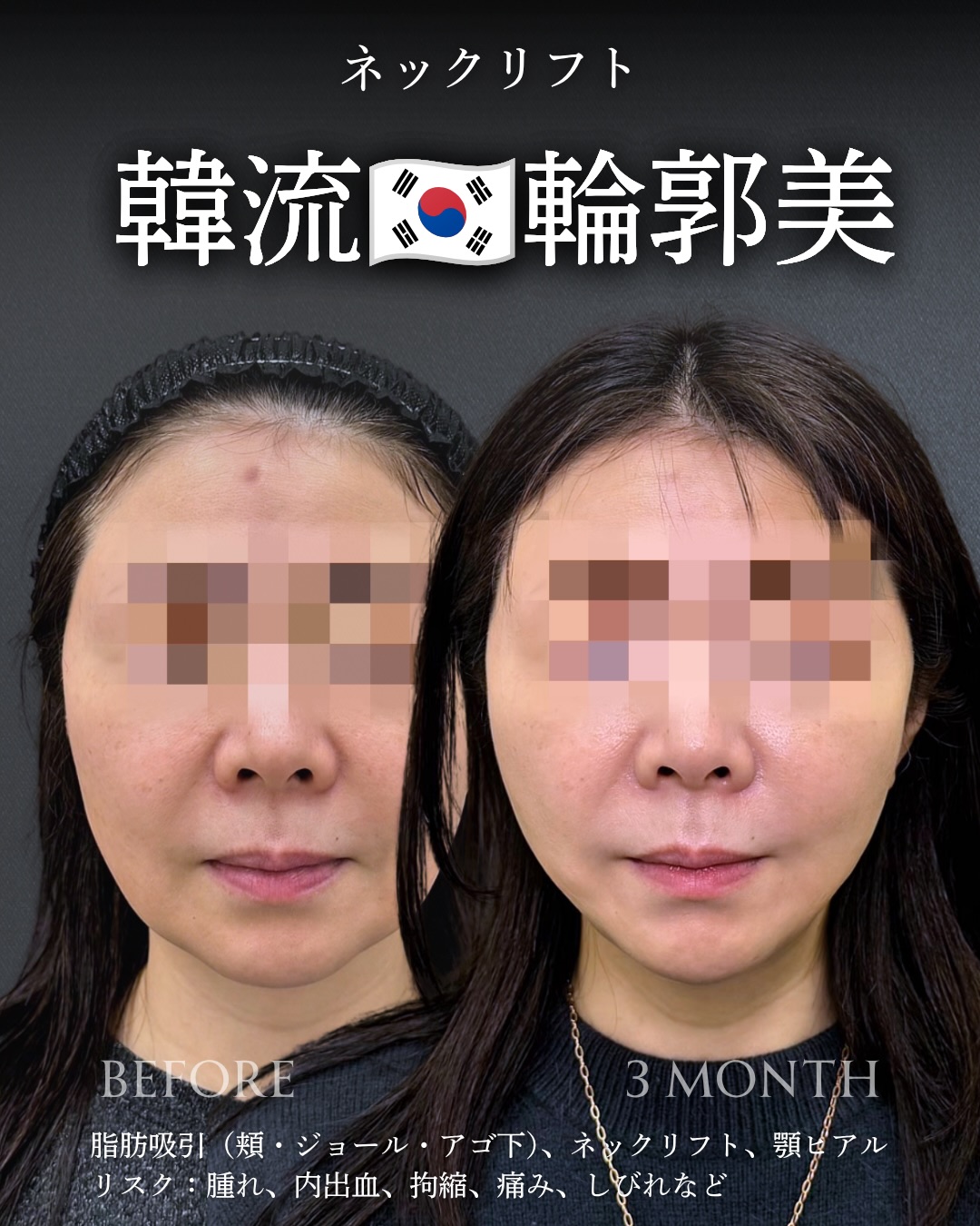 ネックリフトの症例写真 (2)