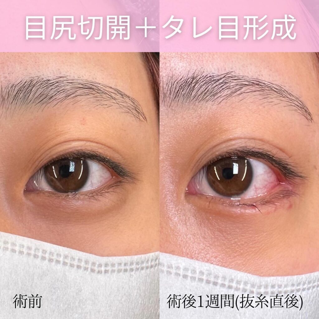 目尻切開とタレ目形成の症例写真