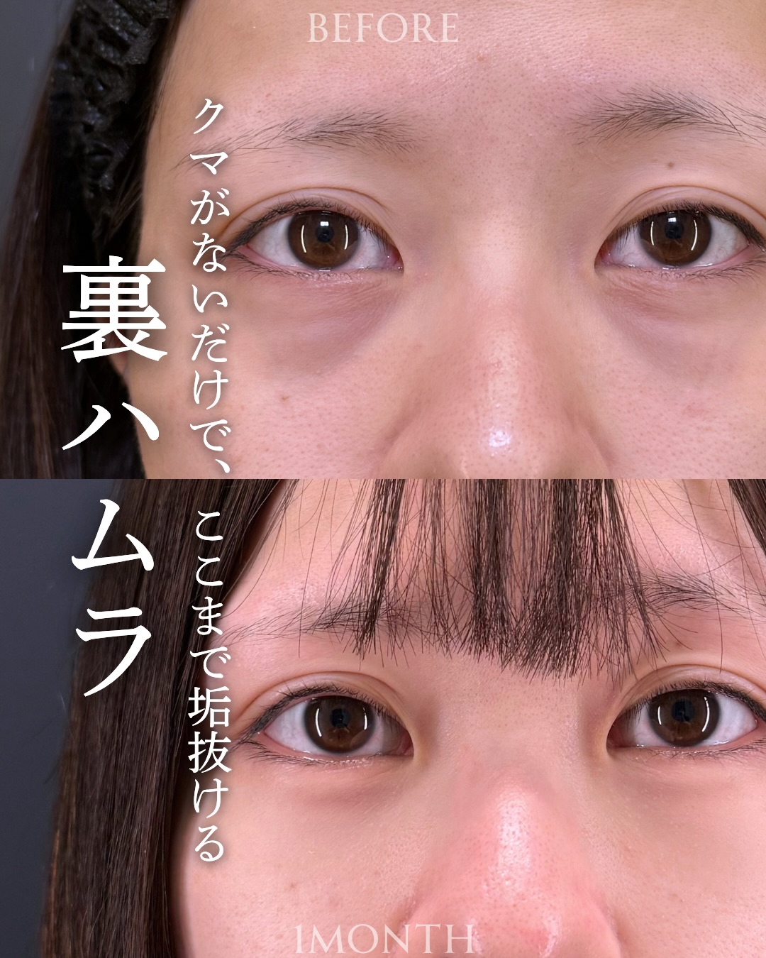 裏ハムラ法の症例写真 (42)