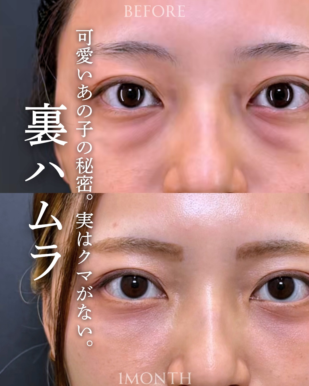 裏ハムラ法の症例写真 (41)