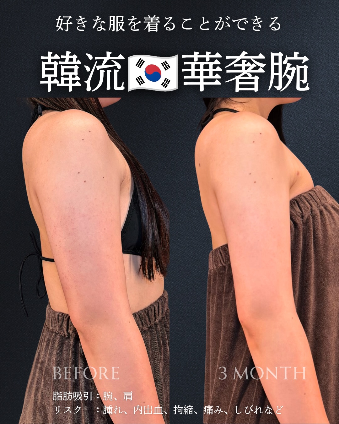 二の腕の脂肪吸引の症例写真 (25)