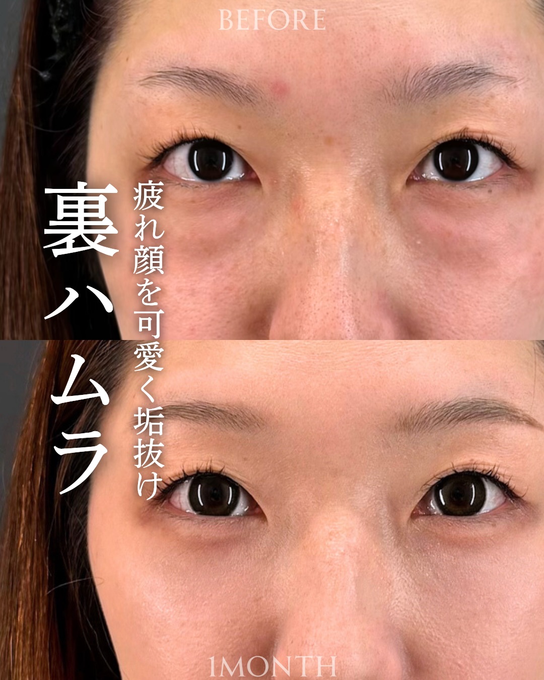 裏ハムラ法の症例写真 (43)