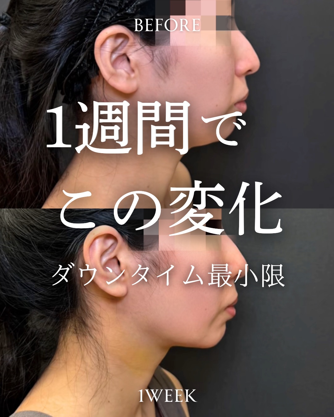 小顔脂肪吸引の症例写真 (1)