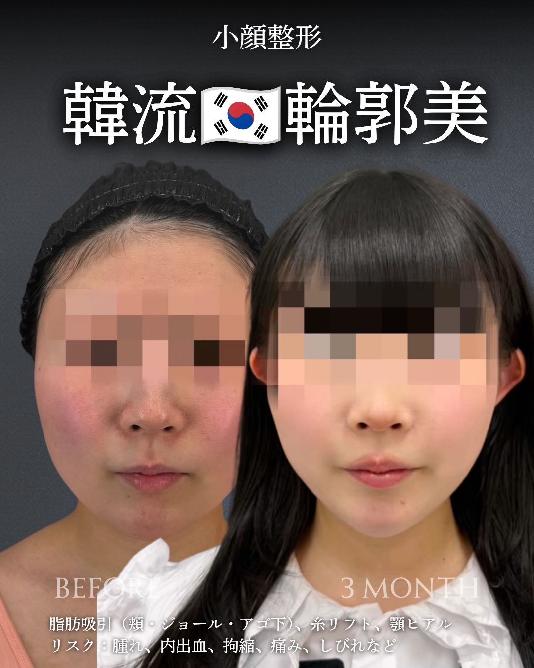 小顔脂肪吸引の症例写真 (2)