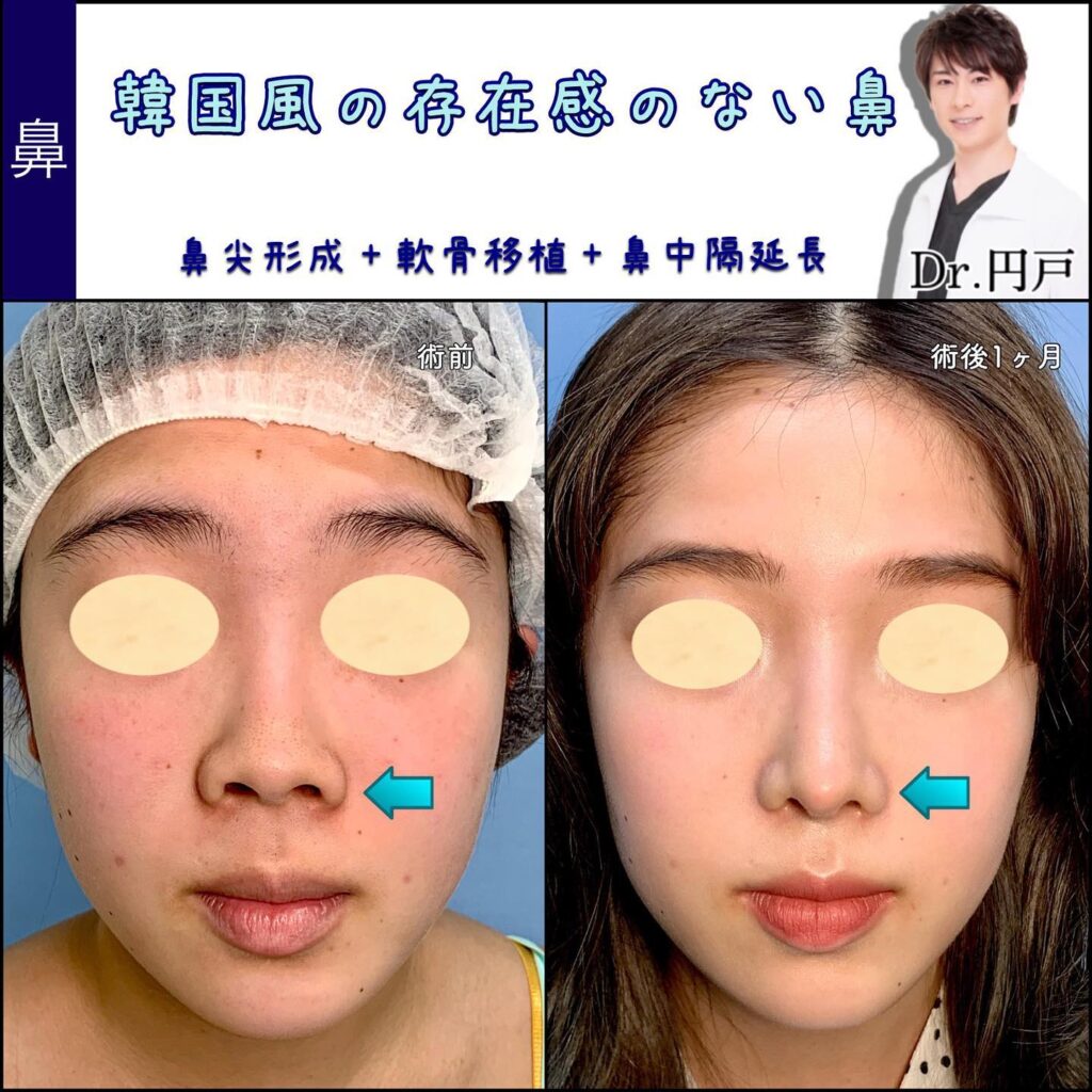 鼻尖形成、軟骨移植、鼻中隔延長を同時に行った１か月後の症例動画