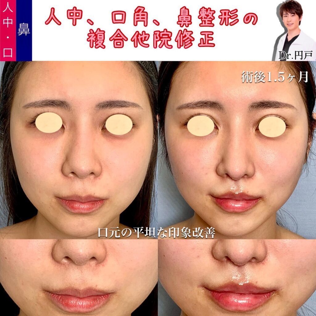 人中短縮と口角挙上と外側人中短縮と鼻の他院修正の症例写真