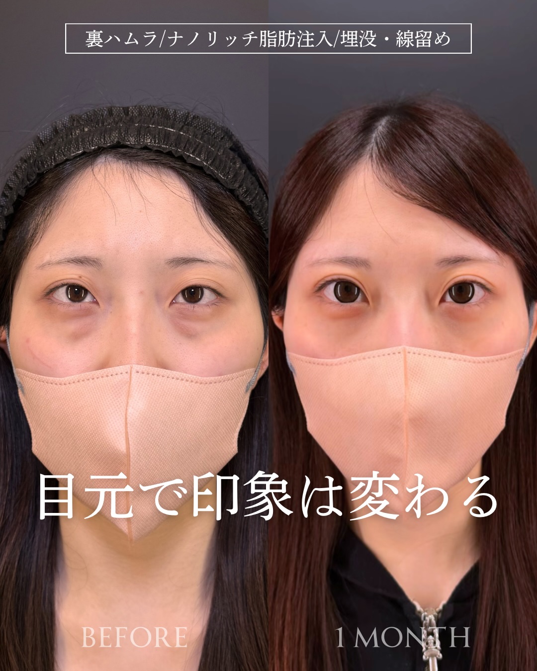 裏ハムラ法とナノリッチの症例写真