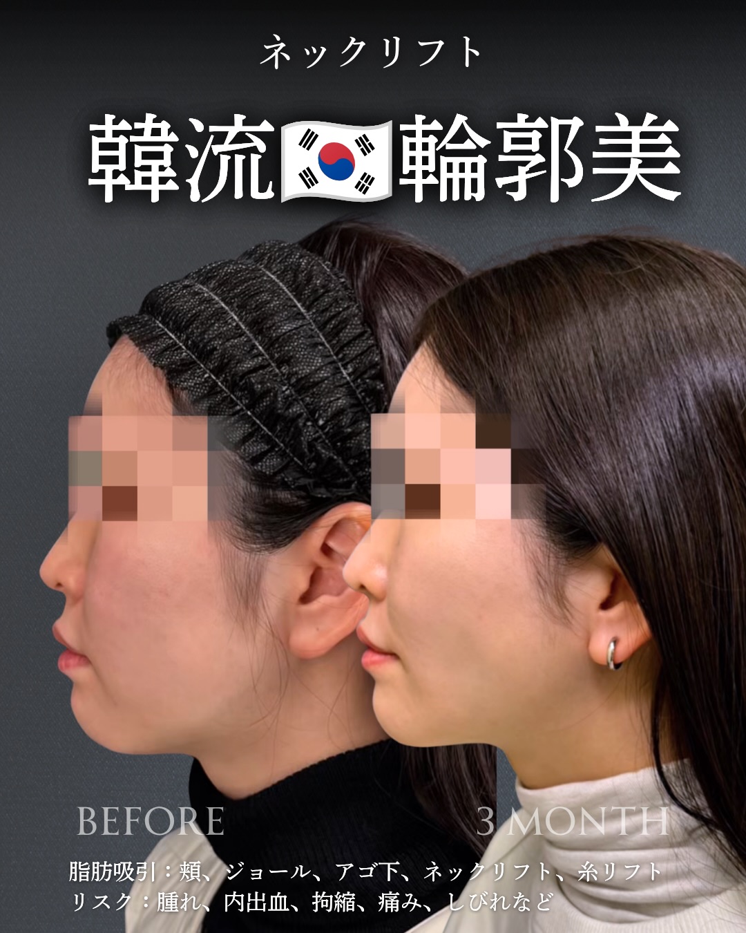 ネックリフトの症例写真 (1)