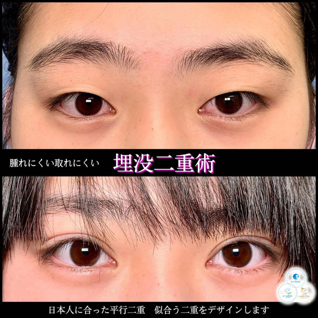 埋没法の症例写真 1