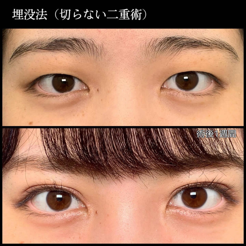 埋没法の症例写真 2